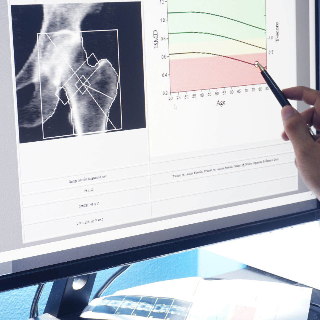 骨密度検査、受けていますか？